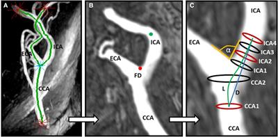 Carotid geometry is independently associated with complicated carotid artery plaques